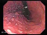 Hyperplastic Gastric Polyposis - Endoscopy (3 of 6) • Video • MEDtube.net