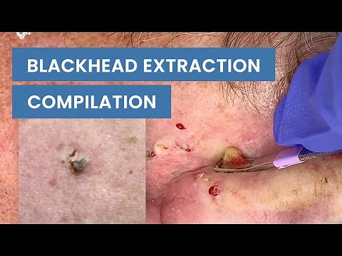 Extraction Satisfaction (Blackhead Removal) | CONTOUR DERMATOLOGY