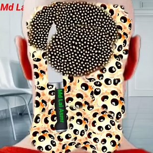 How to get rid of Neck infection and take care #treatment #asmr #videoviralシ #Cilpvideo का पार्ट 6 | Md Lal Asmr