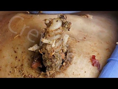 Relaxing Spa Treatment | Removing Blackheads and Dead Skin Gently, burning silence