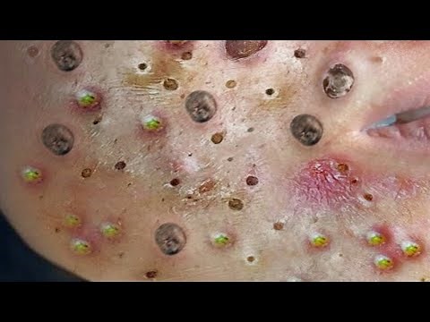 Loan Nguyen Acne Treatment 1446h