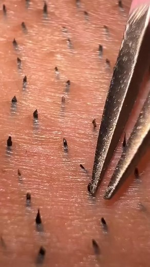 118K views · 407 reactions | Transform Your Look Instantly!  Watch Our Ultimate Mustache Removal Guide Using Tweezers for a Smooth Finished #mustacheremoval | April-09-04 | Facebook