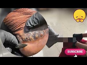 🤯 Extreme Jigger Removal – Hidden Parasites Under Rotting Skin! #QF230