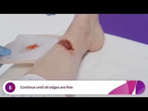 How to Apply and Remove Aquacel® Ag Foam Dressings (Venous Leg Ulcer)