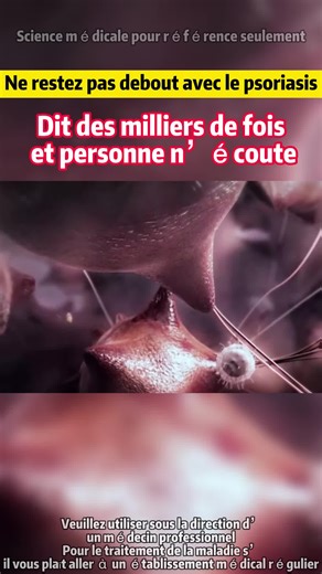 Understanding Psoriasis and Skin Parasites