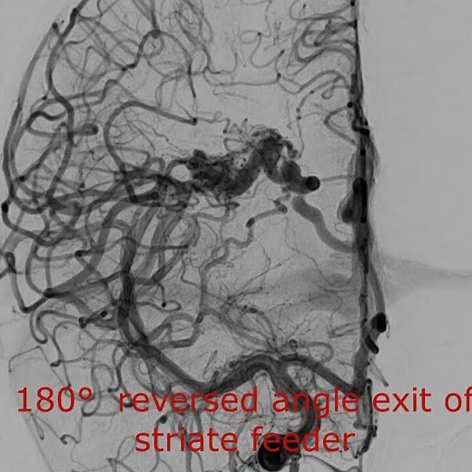 Embolization of the striate feeder of a deep seated AVM with glue