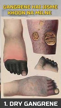 Types of Gangrene | Diabetic Foot | Gangrene | Dr. Gaurav Gangwani