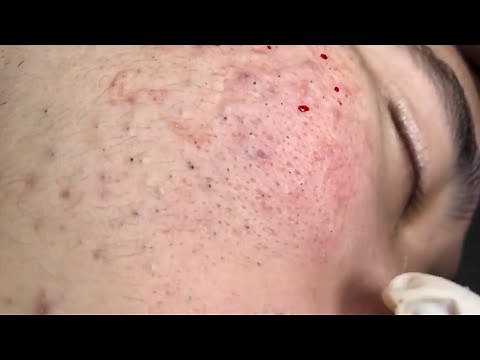 🔥 Pimple Popping 2020 Video| Blackheads full face| Blackheads removal| Acne removal|Acne treatment