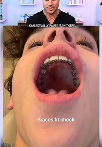 He Has HIDDEN Braces?! 😮🦷 #braces #dentist #teeth | braces