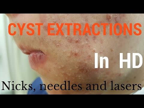 Cysts, extractions, blackheads - Removal methods in HD