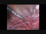 Laparoscopic Hysterectomy Chronic Pelvic Pain • Video • MEDtube.net