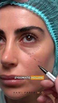 Lower Eyelid Anatomy Explained | Under Eye Bags