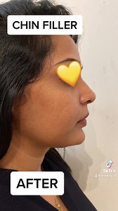 Chin Filler before and after #chin #pointychin #dermalfillers #drcherry | Dr. Sarah Fazy / Dr. Cherry