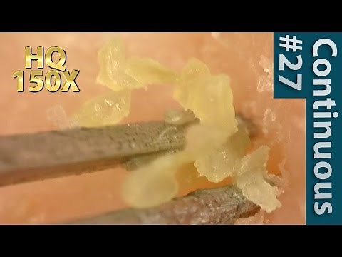 #27 Continuous Removal of Blackheads Close up - Squeezing Blackheads