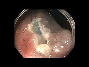 Koloskopie: flache Läsion im Colon transversum - EMR • Film • Medizinisches Portal de.MEDtube.net