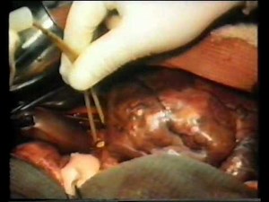 Резекция печени - resection of liver