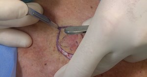 Excision of skin lesions
