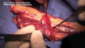 Below Knee Amputation with Nerve Management