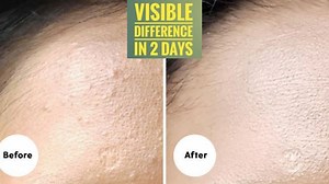 Do This To Remove Those Tiny Bumps On Your Face | Glowpink | Facebook