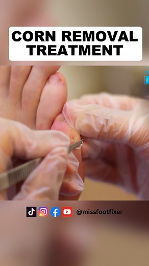 2.9K views | Corn Removal | Corn removal on toe | Clavus mollis entfernen by Miss Foot Fixer #cornremoval #footcornremoval #callusremoval #toenailremoval #satisfyingvideo | Miss Foot Fixer | Facebook