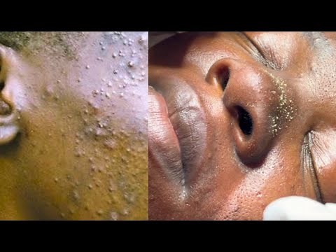 Watch these stubborn pimples get popped (Acne facial Session)