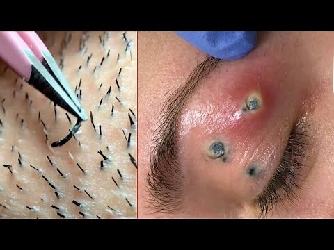 “Extreme Ingrown Hair Extraction – Blackhead Like You’ve Never Seen!”