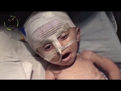 Starving children dying in Syria