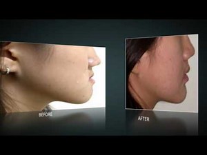 Why the long face? Amazing Makeover of a teenager with long face and protruding jaw.