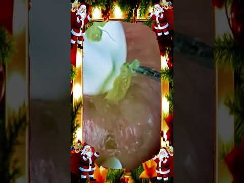 Blackheads Removal #255 | Acne Treatment and Very Satisfying Satisfying Pimple pop #blackheads