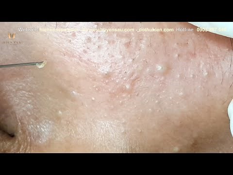 How to pop acne,lackheads,cyst under skin at Hien Van Spa-413