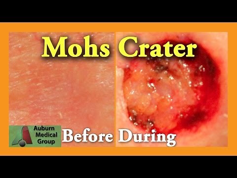 Mohs Surgery: Part 1 | Auburn Medical Group