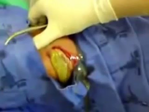 The Grossest Infection I've Ever Seen Drained! Cyst Pimple Boil Synthol