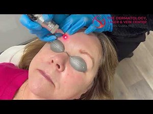 Laser Tattoo Removal on Eyebrows | Dr. Shalini Gupta