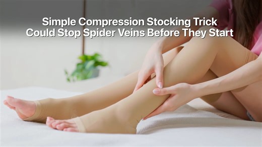 Simple compression stocking trick could stop spider veins before they start