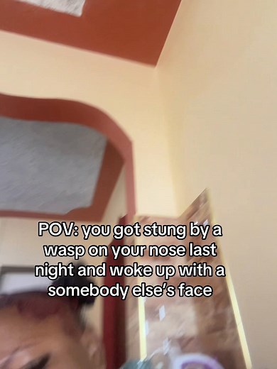 POV: Wasp Sting on Nose — Swollen Face Reaction and Recovery