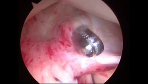 Arthroscopic Capsular Release for Adhesive Capsulitis of the Shoulder