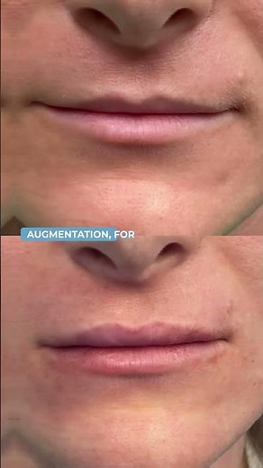 RHA Filler: Minimal Recovery, Maximum Results #fillers #facialcosmeticsurgery #cosmeticsurgeon