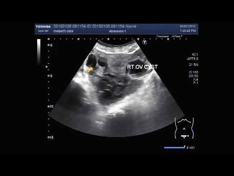 Ultrasound Video showing multiple adhesions in between the female genital organs.