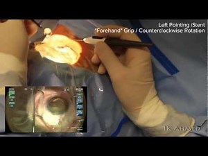 iStent Hand and Scope Position Ike Ahmed Narration (720p).m4v