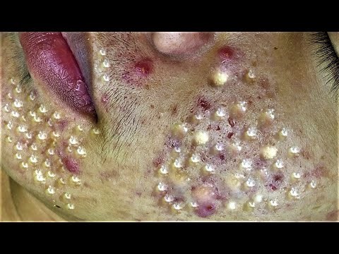 Relax Every Day With Loan Nguyen Spa | Acne Treatment Pimple Popping #49