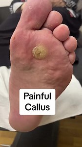Warch and learn from a podiatrist as he removes a painful callus from the foot of a patient #docpods #ergonx #corn #callus #satisfying #fyp #podiatrist #podiatry it can be very satisfying to watch | Piesperfectosmx