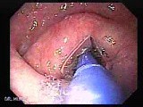 Achalasia - Guidewire For Esophageal Dilation - 3/4 • Video • MEDtube.net