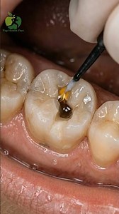 Fixing a Broken Molar Tooth | Cracked tooth repair #SatisfyingDental #ToothRepair #FixYourSmile