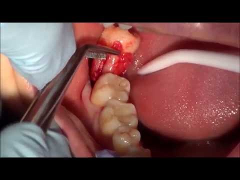 Tooth Extraction & World's Ugliest Mouth x