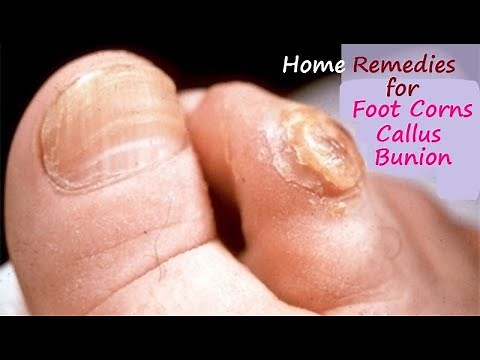 Home Remedies for Foot Corns and Calluses, Bunion II Foot Corn Removal at Home II Corns on Feet