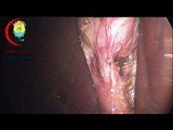 Long Cystic Duct Dissection • Video • MEDtube.net