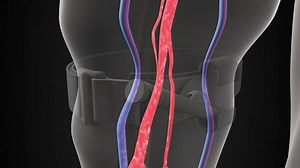 3D illustration of a tourniquet stopping blood flow | First Aid Coaching | Facebook