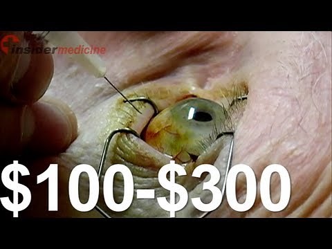 Avastin Riskier than Lucentis in Eye Injections for Macular Degeneration