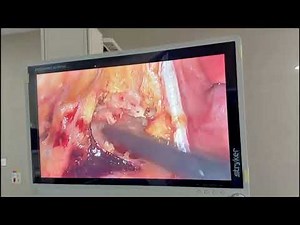 Laparoscopic Rectopexy For Rectal Prolapse Dr Aditya Sharma MCh (GI Surgery)