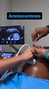 Amniocentesis – Key Facts Every Nurse Must Know What it is A diagnostic procedure performed from 15–20 weeks gestation involving transabdominal aspiration of 15–20 mL of amniotic fluid under continuous ultrasound guidance. Primary Indications - Prenatal genetic diagnosis (karyotyping, microarray, single-gene testing) - Fetal lung maturity assessment (L/S ratio, lamellar body count) - Diagnosis of intra-amniotic infection (Gram stain, culture, PCR) - Evaluation of severe rhesus isoimmunisation (b